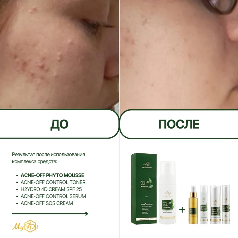 Мусс очищающий для проблемной кожи Acne-Off phyto mousse, 150 мл - фото №3