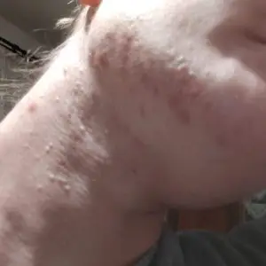 Photo from a customer review of Протизапальна локальна есенція Acne-Off local essence, 15 мл